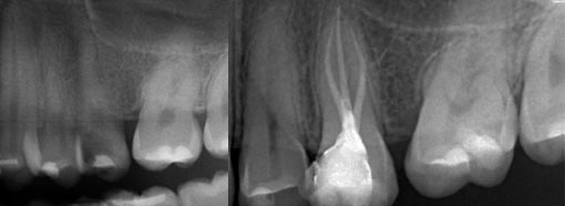 Radiografía con el antes y después de una endodoncia