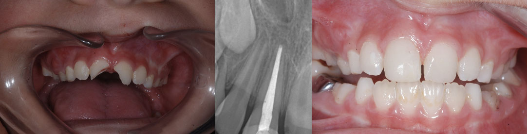Antes y Después de un Paciente tras Odontología Conservadora