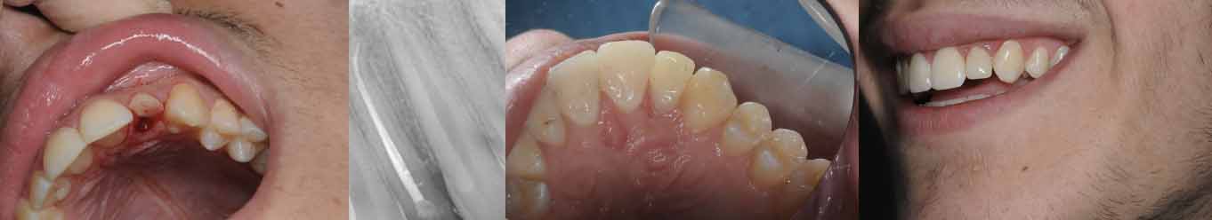 Antes y Después de Odontología Conservadora