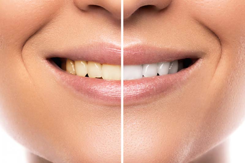 Antes y Después del Blanqueamiento Dental