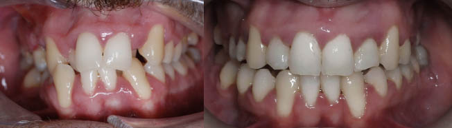 Antes y después de la ortodoncia en paciente con dientes apiñados