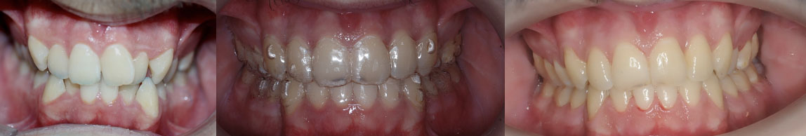 Antes y Después de la Ortodoncia Invisible con Apiñamiento