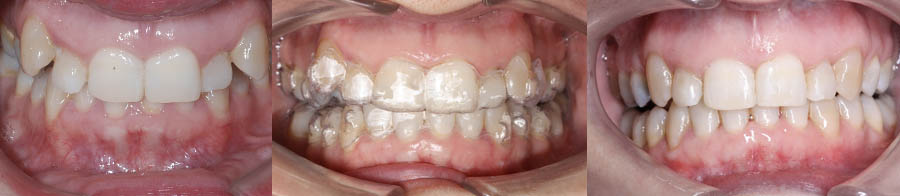 Antes y después de ortodoncia Invisalign en paciente con dientes apiñados