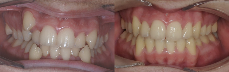 Antes y después de ortodoncia invisible en dientes apiñados