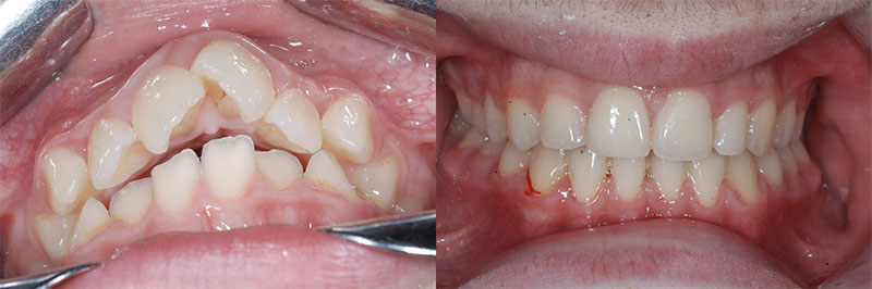 Antes y después de la ortodoncia en paciente joven con apiñamiento