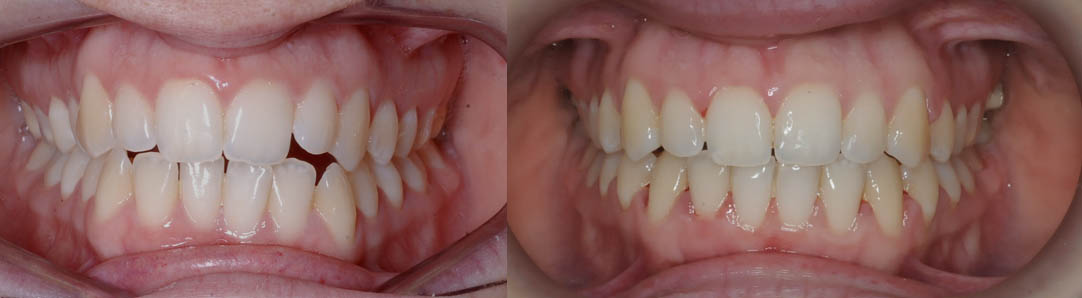 Antes y después de la ortodoncia en un paciente con problemas de mordida abierta