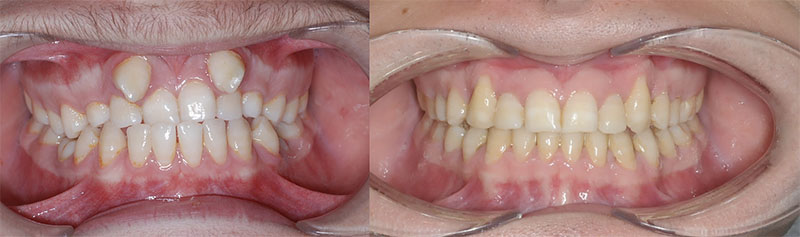 Antes y después de la ortodoncia en paciente con transposición de caninos