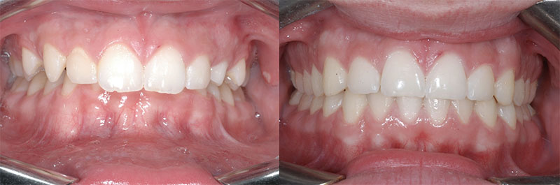 Antes y Después de la Ortodoncia en un Paciente con Sobremordida