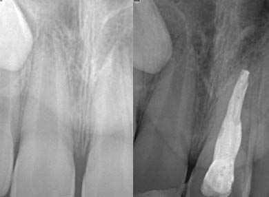 Radiografía con el antes y después de una endodoncia