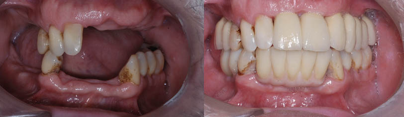 Antes y después de la boca de un paciente tras la implantologia