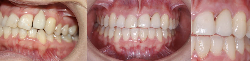 Antes y después del injerto dental en paciente adulto