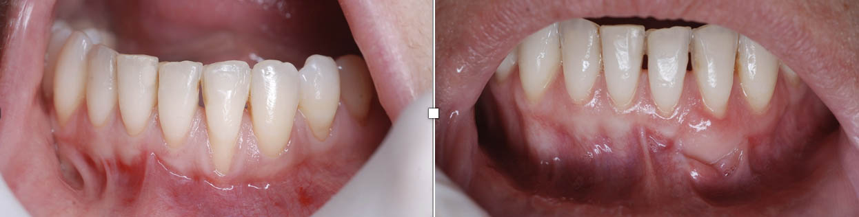 Antes y Después del Injerto Dental a un Paciente con Recesión de Caninos