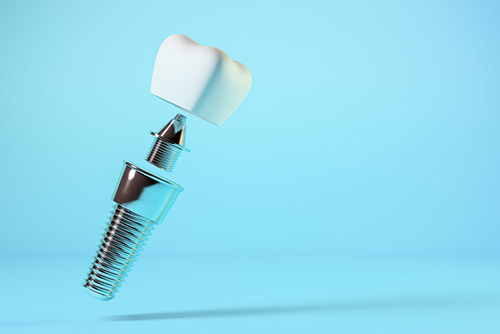 Prótesis de Implante Dental