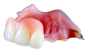 Prótesis Dental Parcial Removible