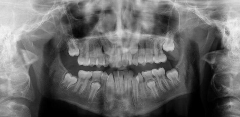 Radiografía Dental Panorámica