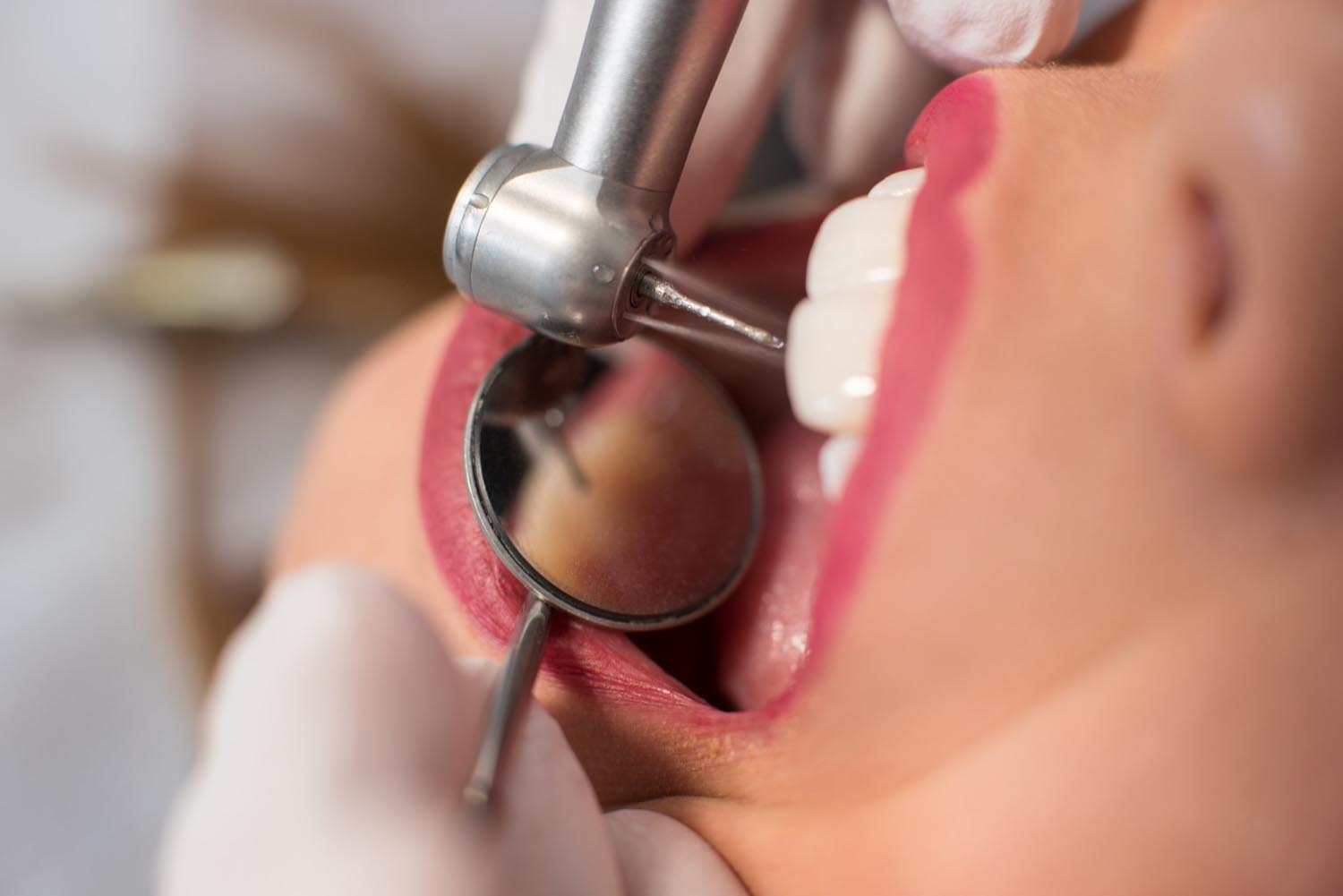 Paciente Realizándose un Recontorneado Dental