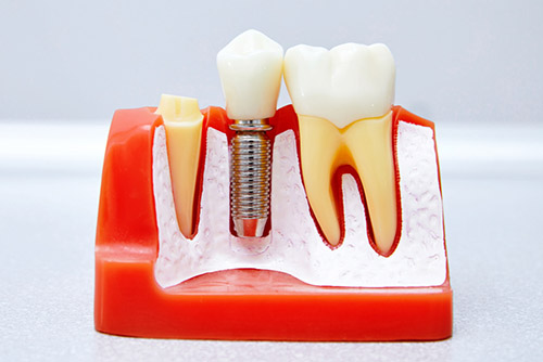 Sección Implante Dental en la Raíz